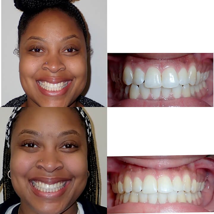 Before-after-dental-trainer-results-reviews